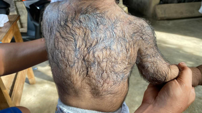 Concern as babies develop bizarre 'werewolf syndrome' after parents use popular hair loss remedy